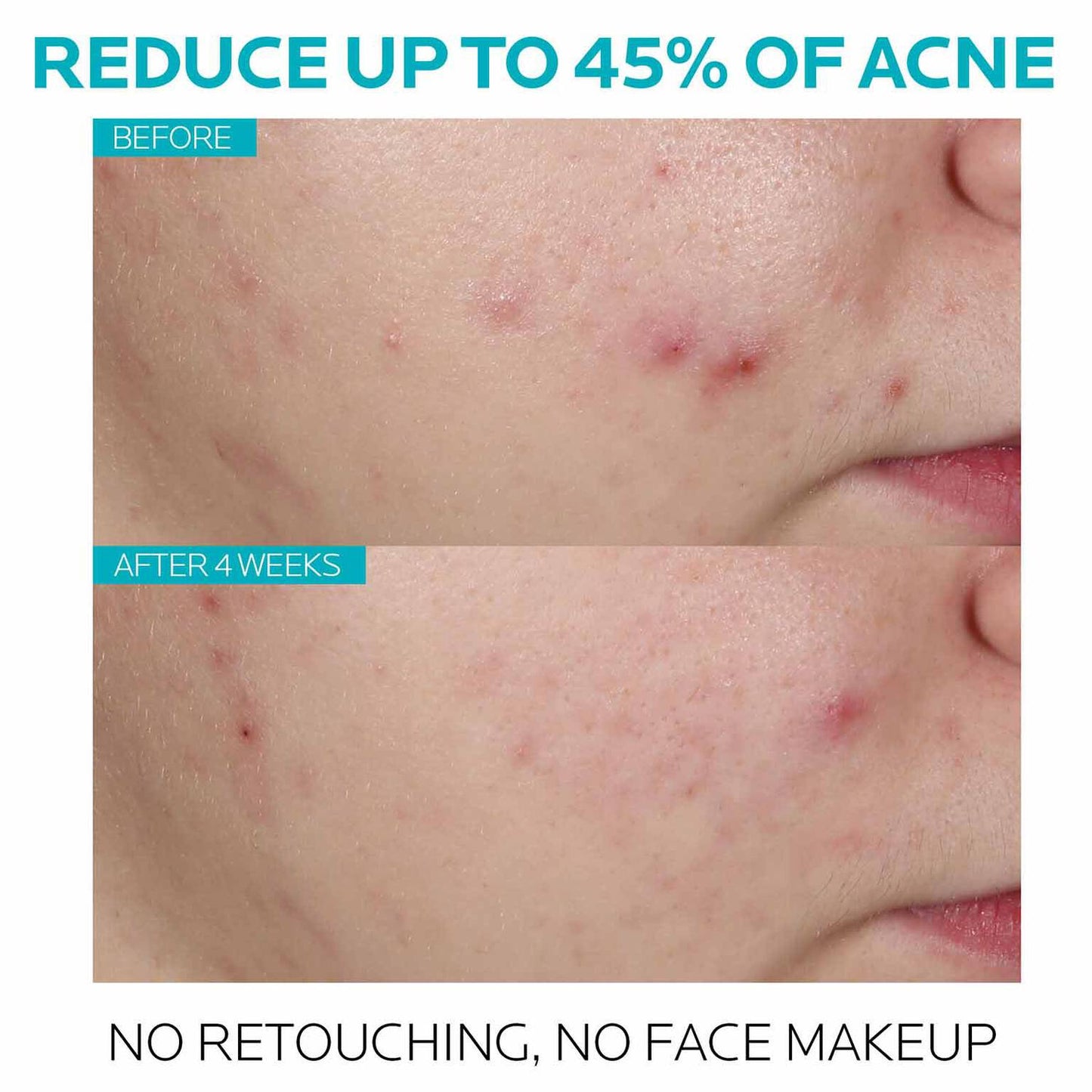 effaclar-salicylic-acid-acne-treatment-serum-c2 7_EffaclarSerum_After-45-days.jpg