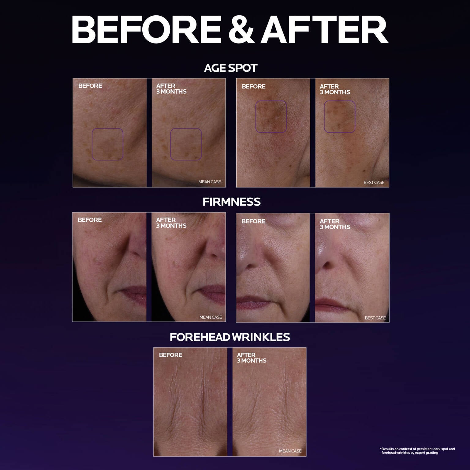 mela-b3-double-dose-discoloration-treatment-with-melasyltm-l6 MelaB3_DD_BTF_BeforeAfter_1500x1500_5.jpg