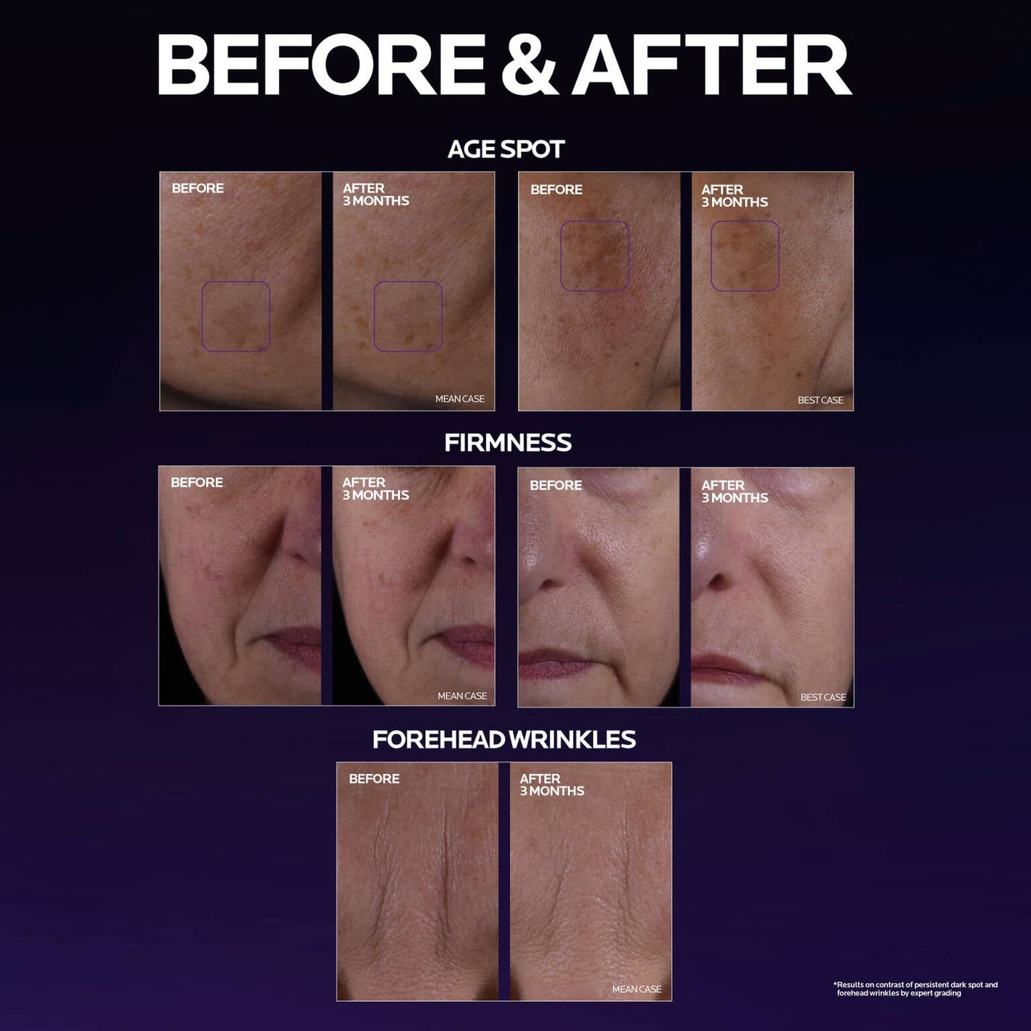 mela-b3-double-dose-discoloration-treatment-with-melasyltm-p8 MelaB3_DD_BTF_BeforeAfter_1500x1500_5.jpg